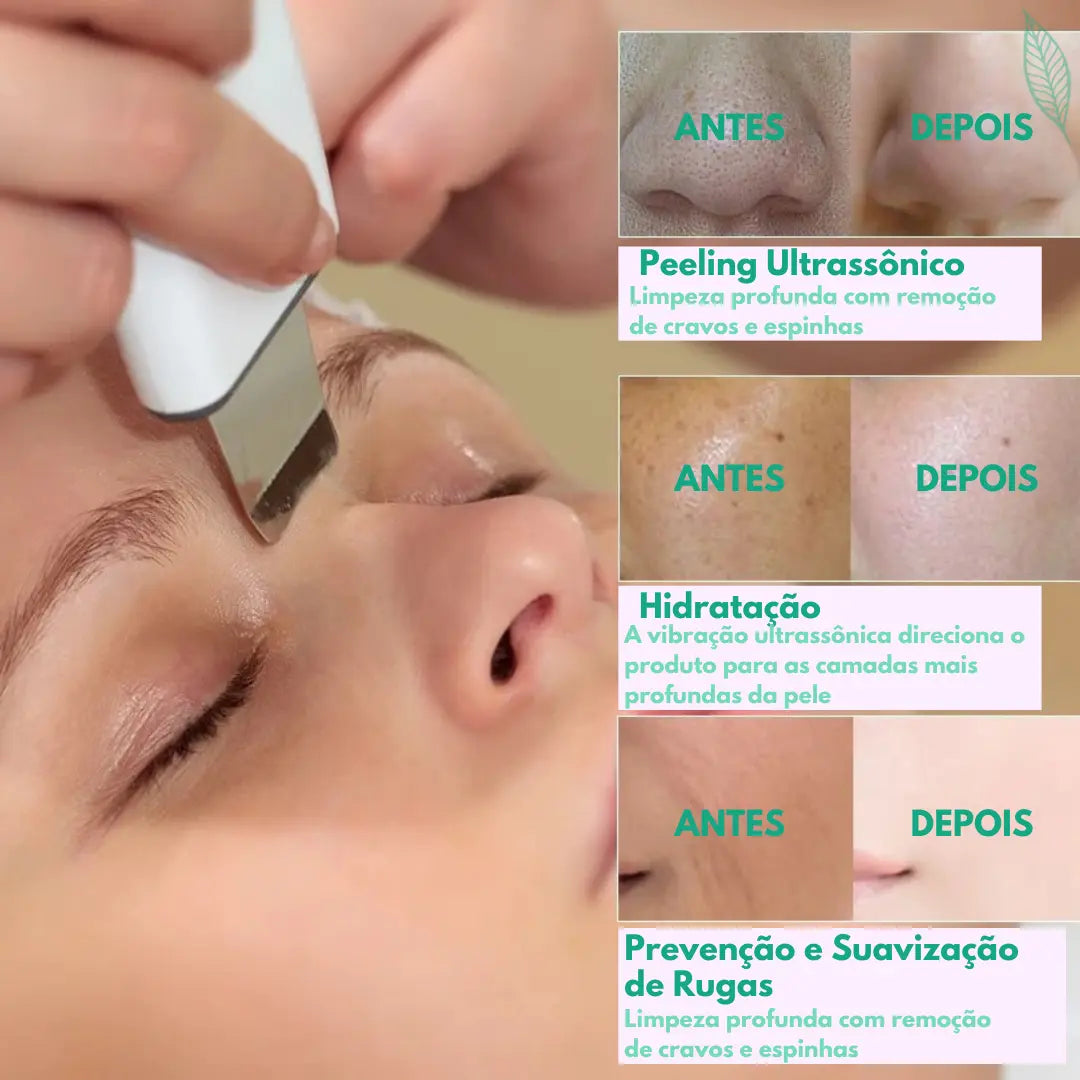 Peeling Ultrassônico de Tratamento e Limpeza Profunda RenovaSkin®