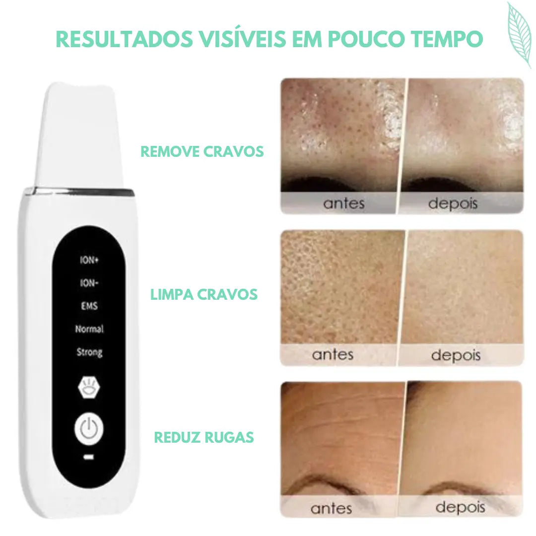 Peeling Ultrassônico de Tratamento e Limpeza Profunda RenovaSkin®